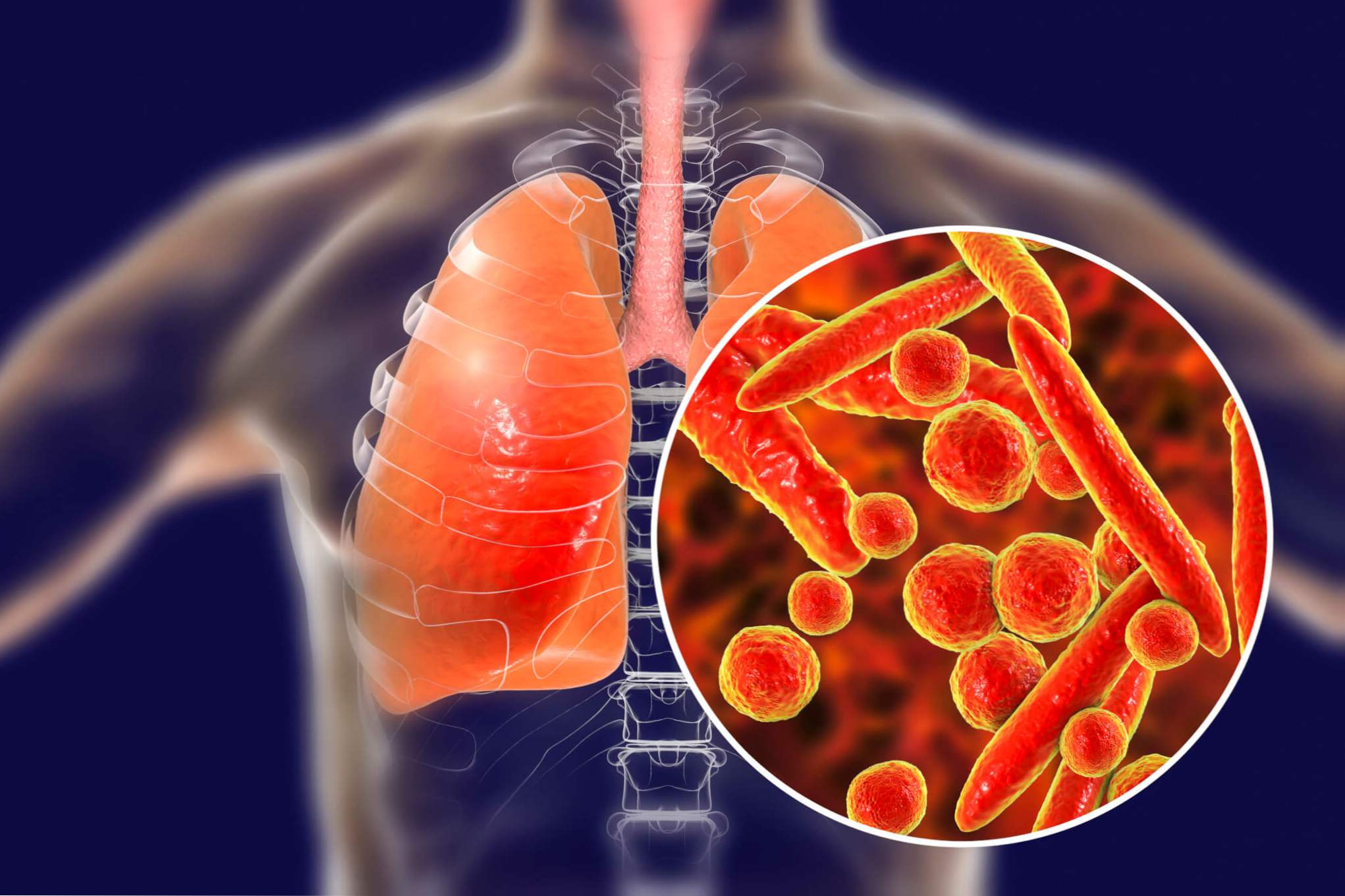 Jakie są objawy zapalenia płuc u dorosłych i dzieci, diagnoza, rodzaje, możliwe powikłania, leczenie choroby