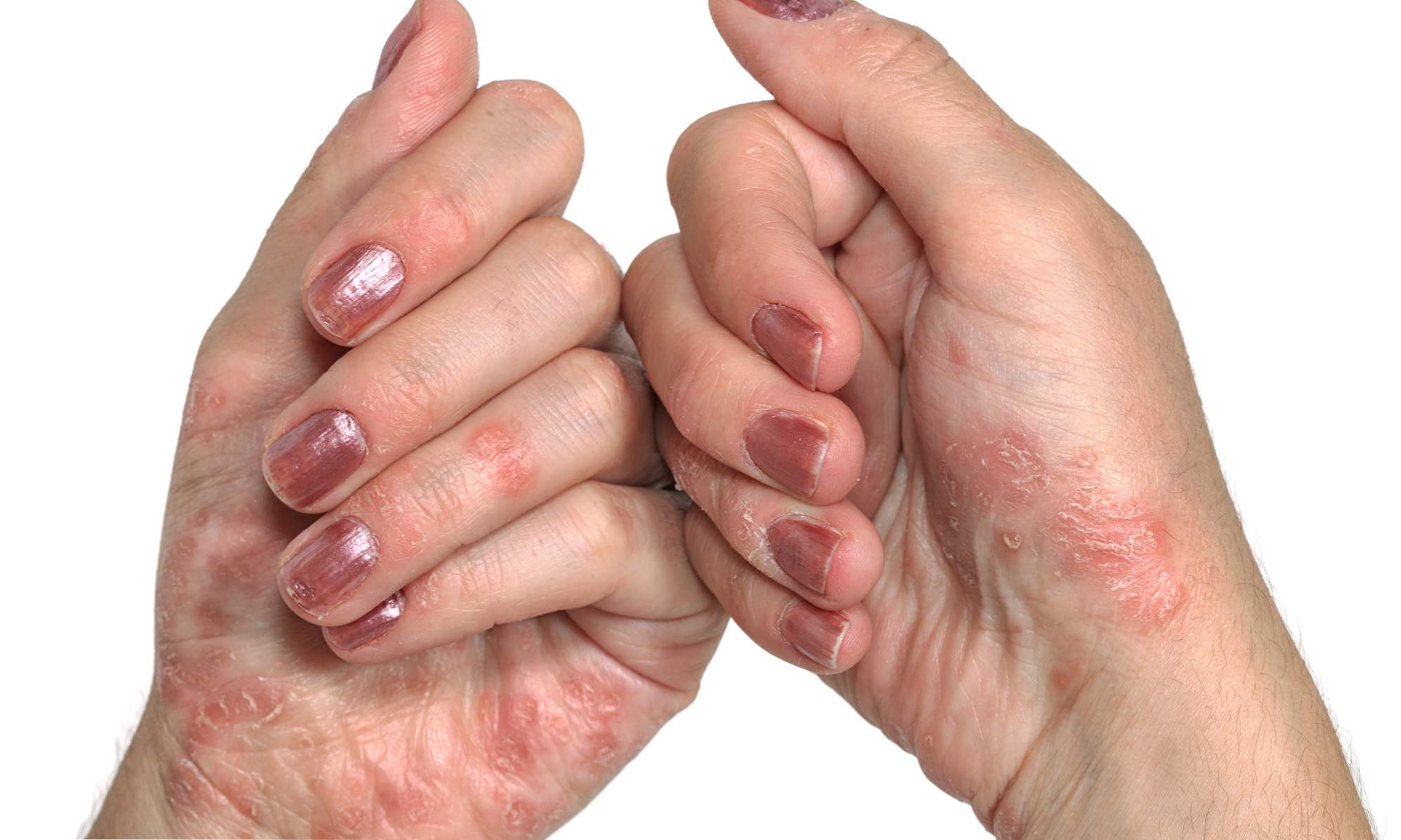 Psorijaza na rukama simptoma i liječenje ljuskavog lišavanja