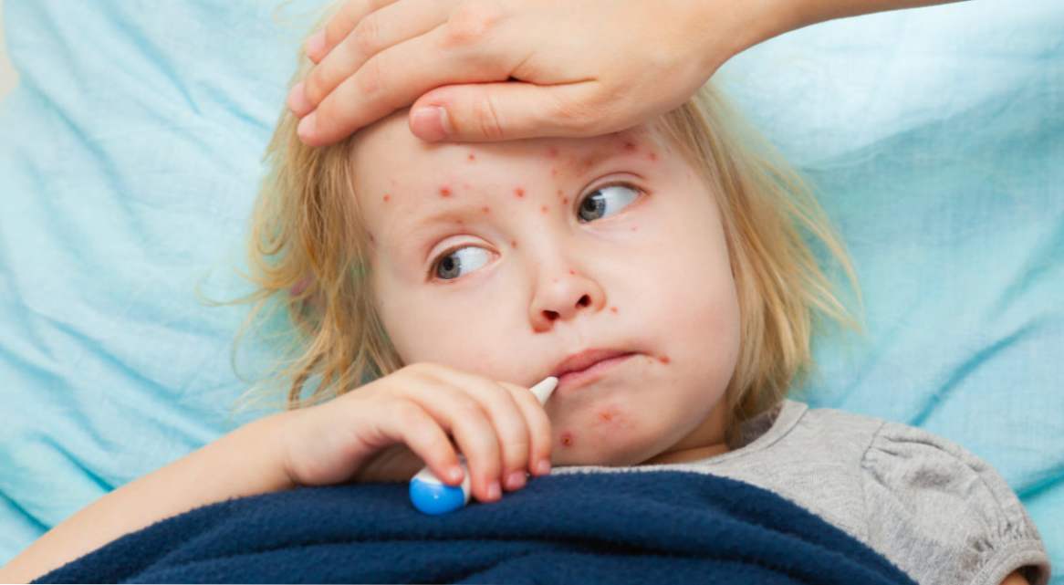 Кір симптоми у дітей, перші ознаки вірусного захворювання, лікування, профілактика