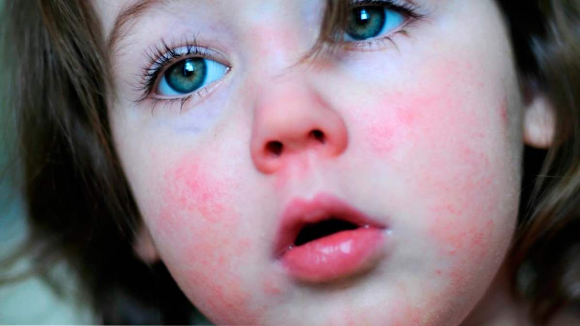 Grimizna groznica u djece simptoma i liječenja, koja je bolest i kako se prenosi?