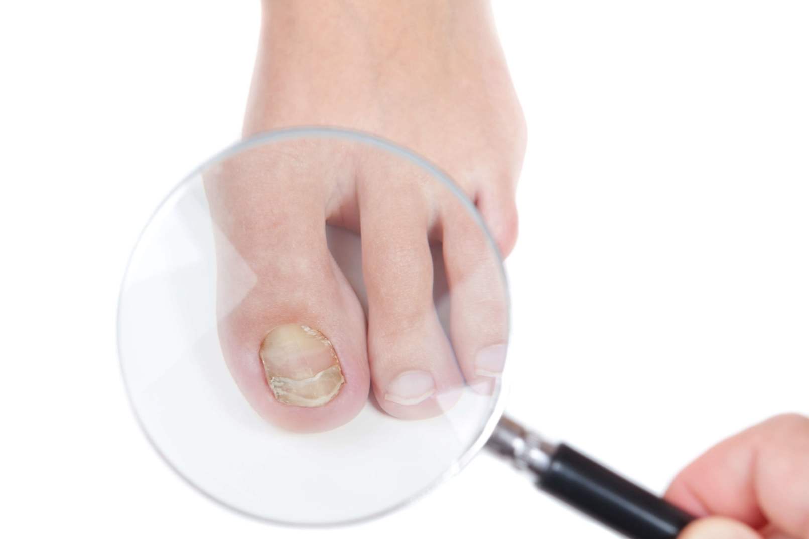 Засіб від грибка нігтів на ногах - найефективніші препарати і народні засоби
