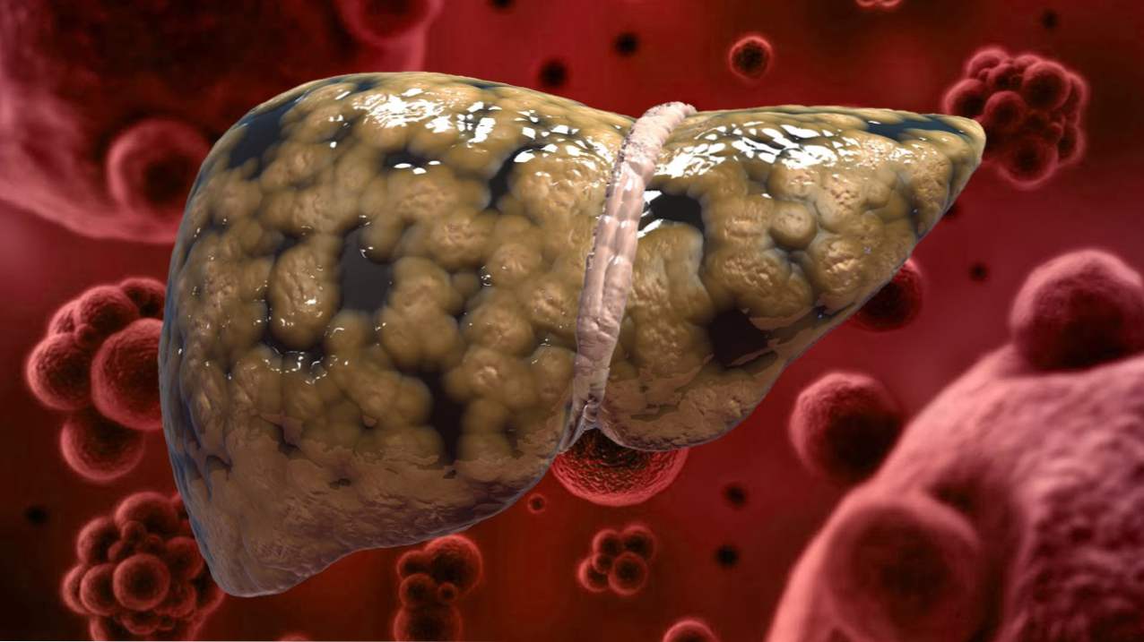 Maščobna hepatoza jeter - simptomi in zdravljenje z zdravili in ljudskimi pravili