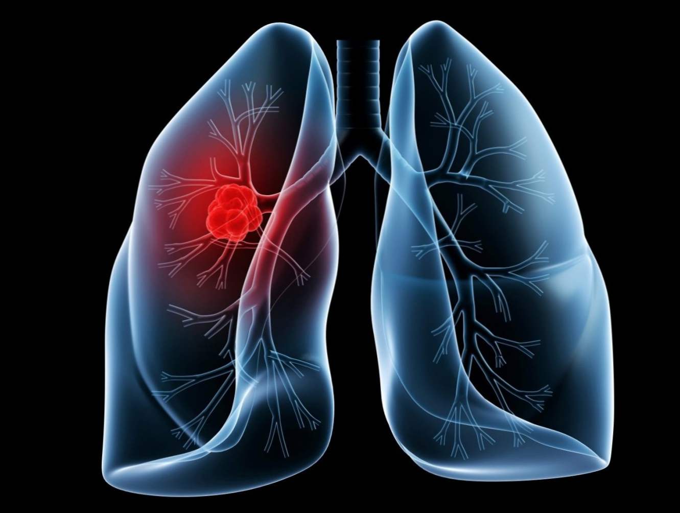 Sarkoidoza płuc - co to jest? Objawy i leczenie choroby