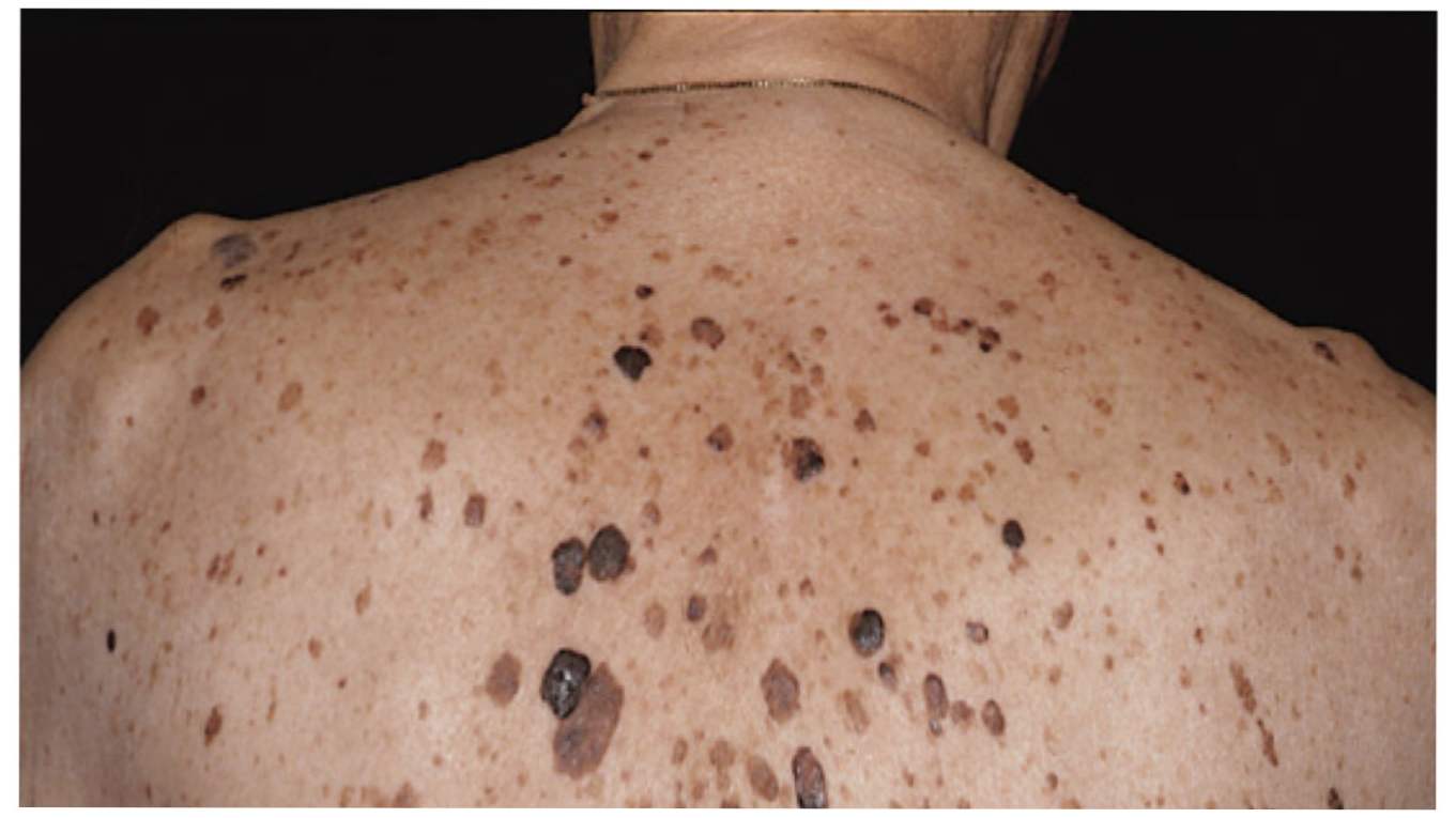 Себорейний кератоз шкіри що це і як лікувати
