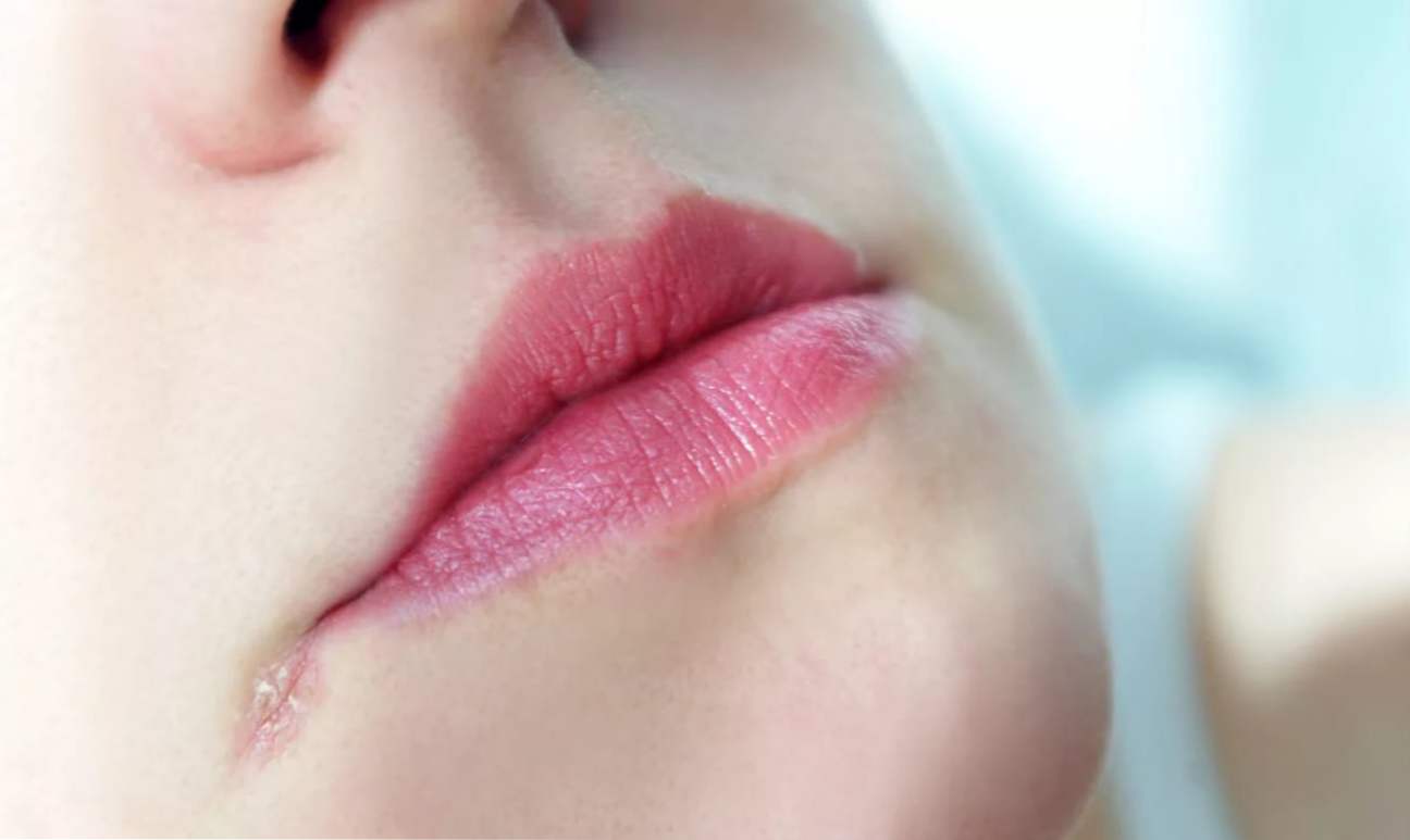 Bity v rohoch úst, príčiny a rýchle ošetrenie modrín a trhlín